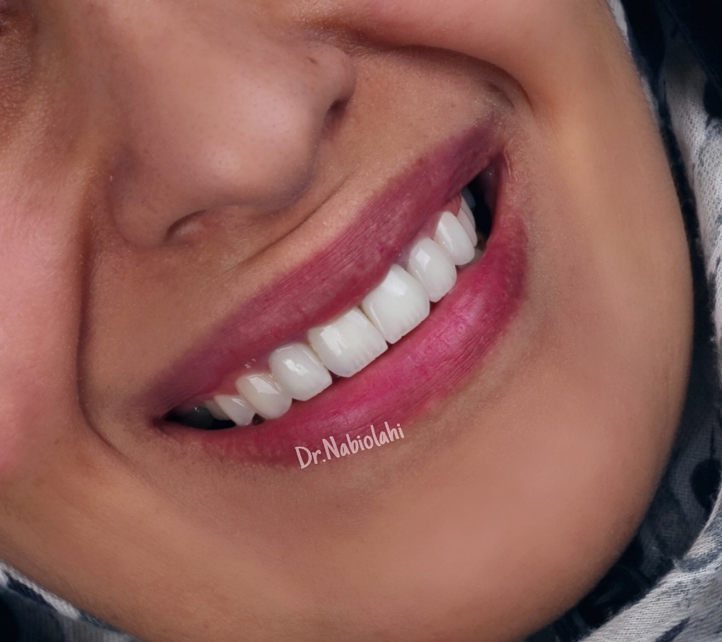 لمینت سرامیکی