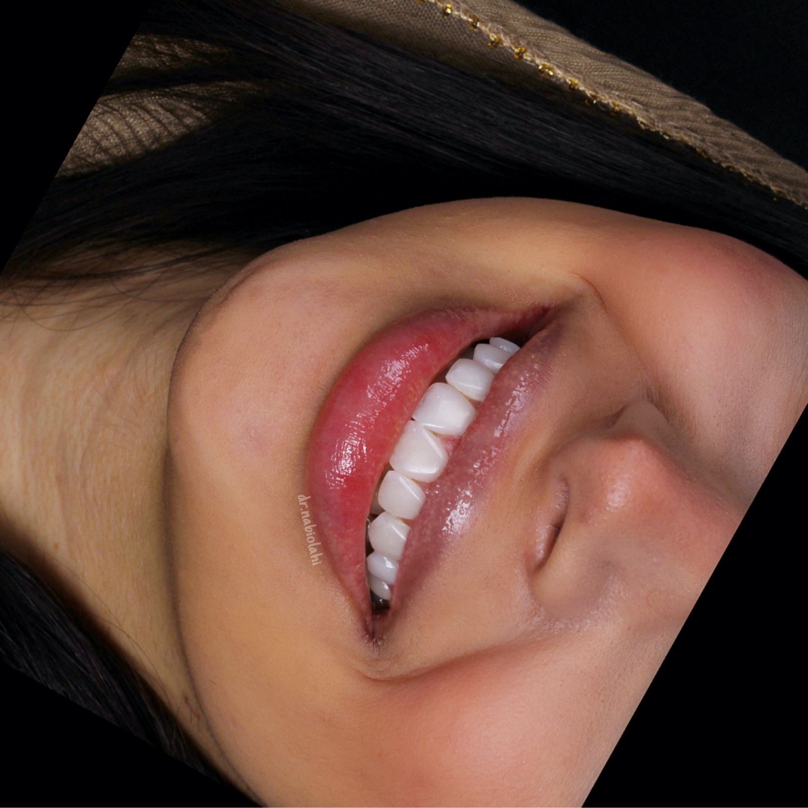 ونیر کامپوزیت