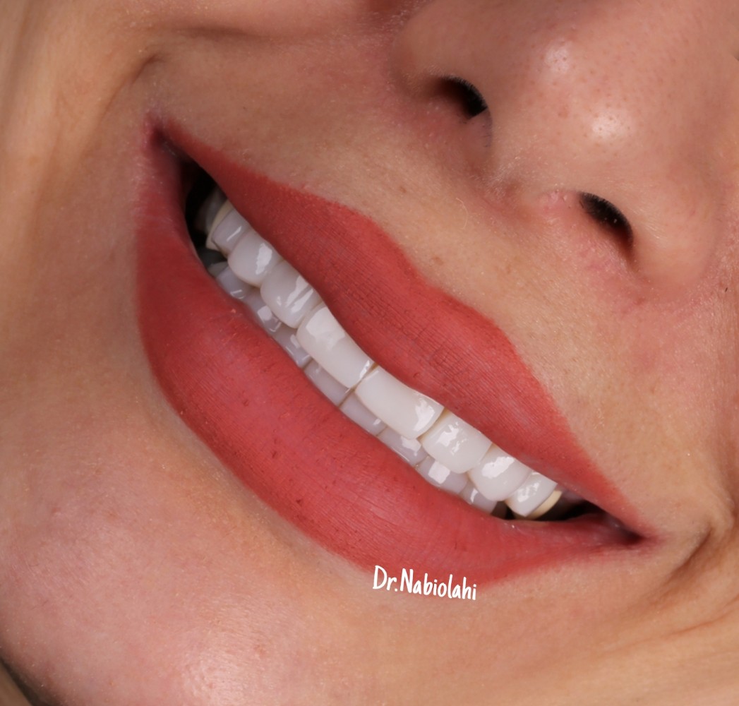 ونیر کامپوزیت