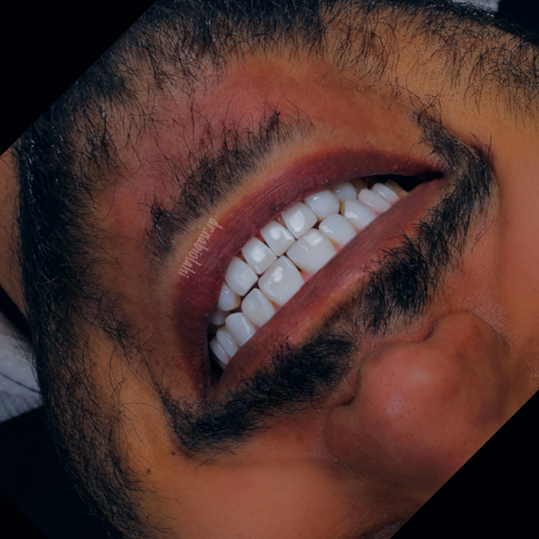 ونیر کامپوزیت