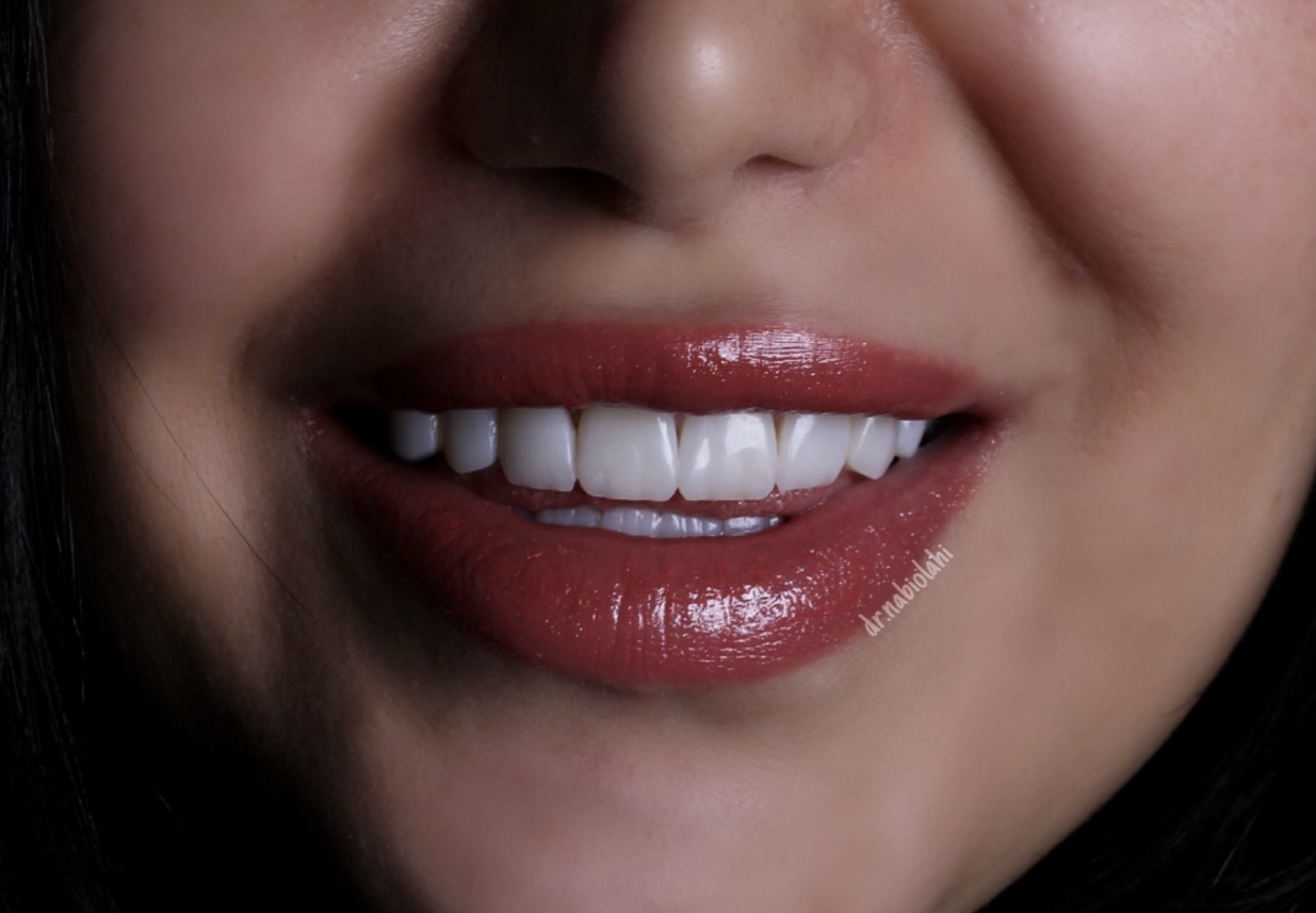 ونیر کامپوزیت . لمینت سرامیکی . بلیچینگ