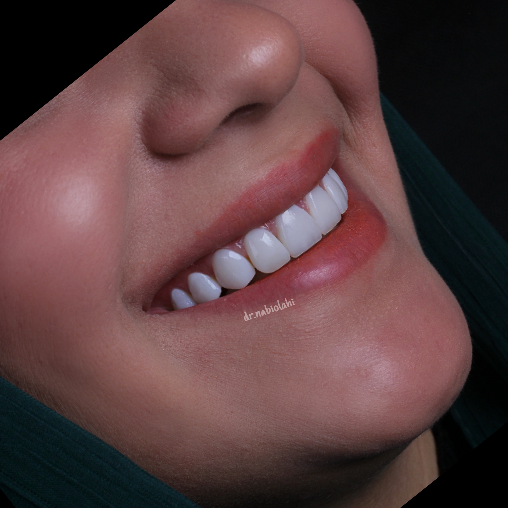 ونیر کامپوزیت