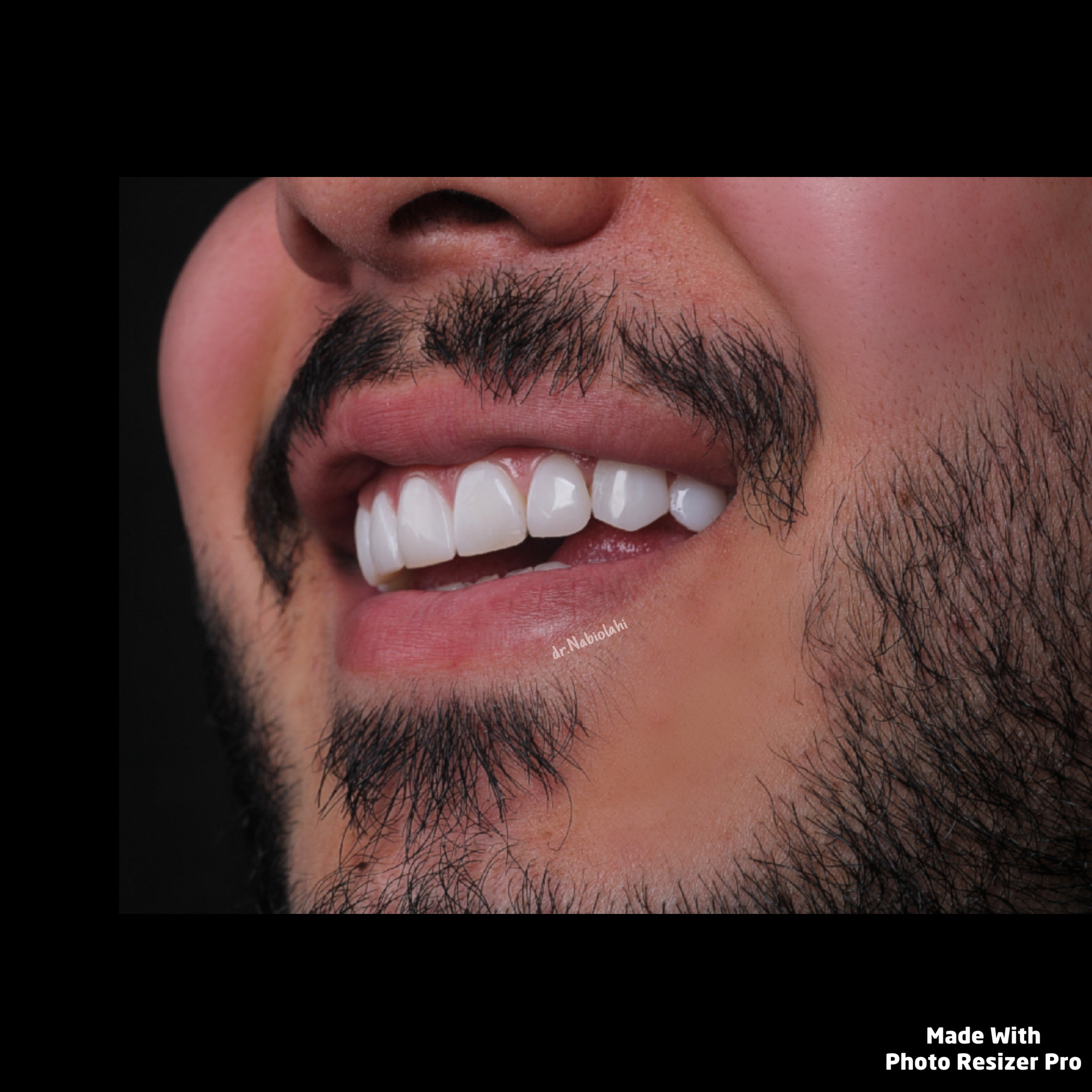 ونیر کامپوزیت