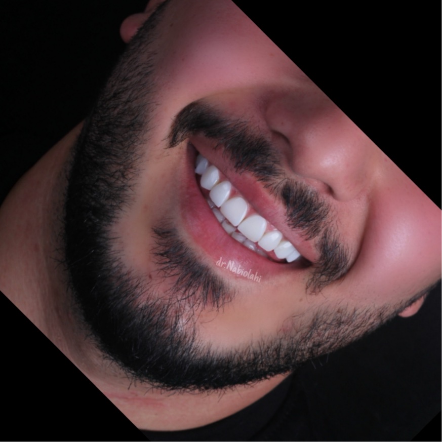 ونیر کامپوزیت