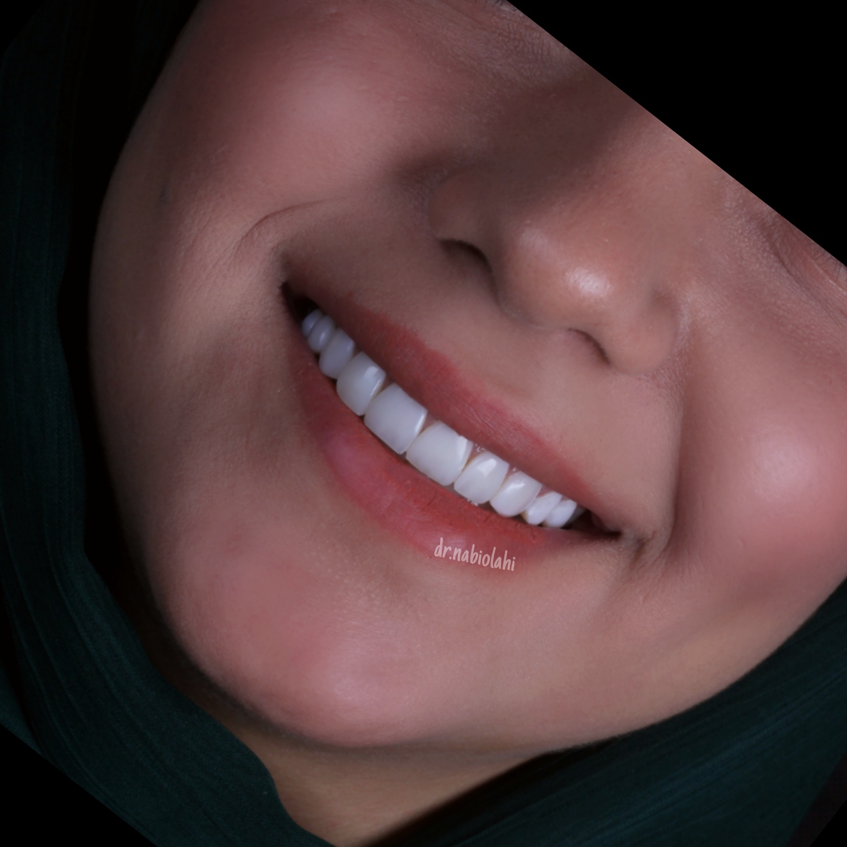 ونیر کامپوزیت