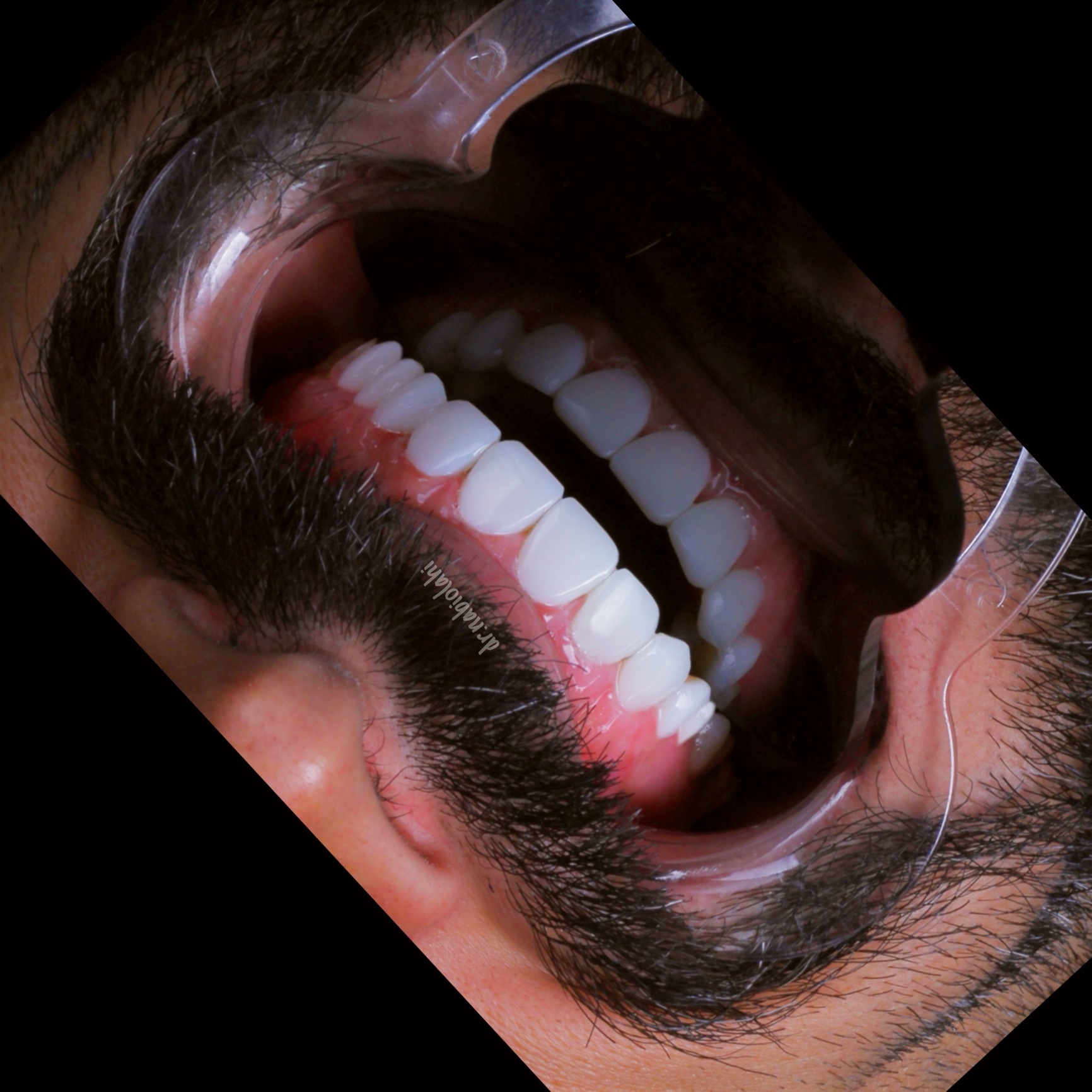 ونیر کامپوزیت