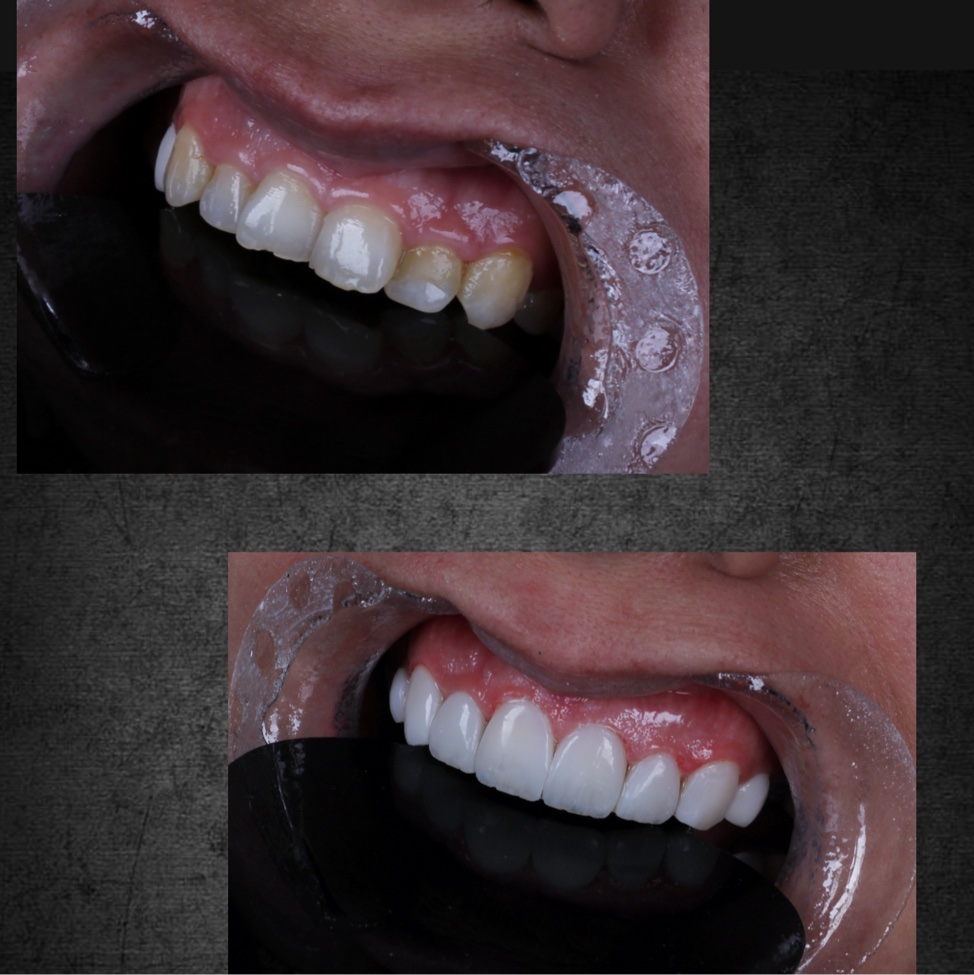 ونیر کامپوزیت