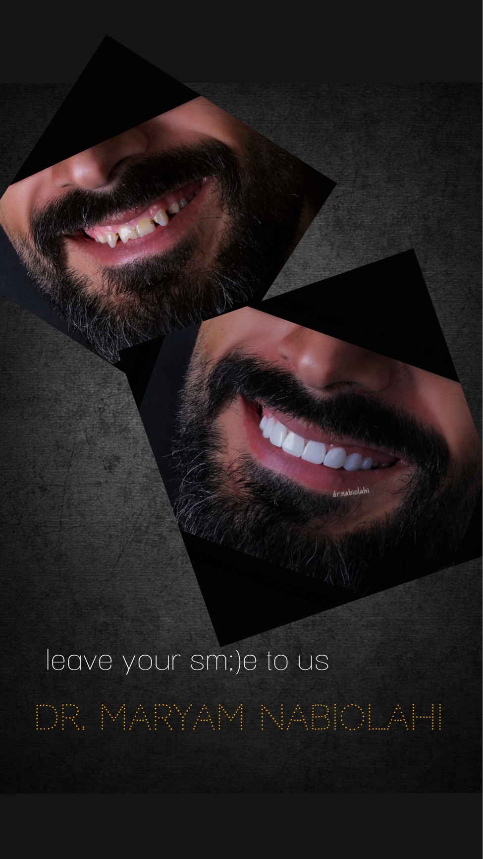 ونیر کامپوزیت