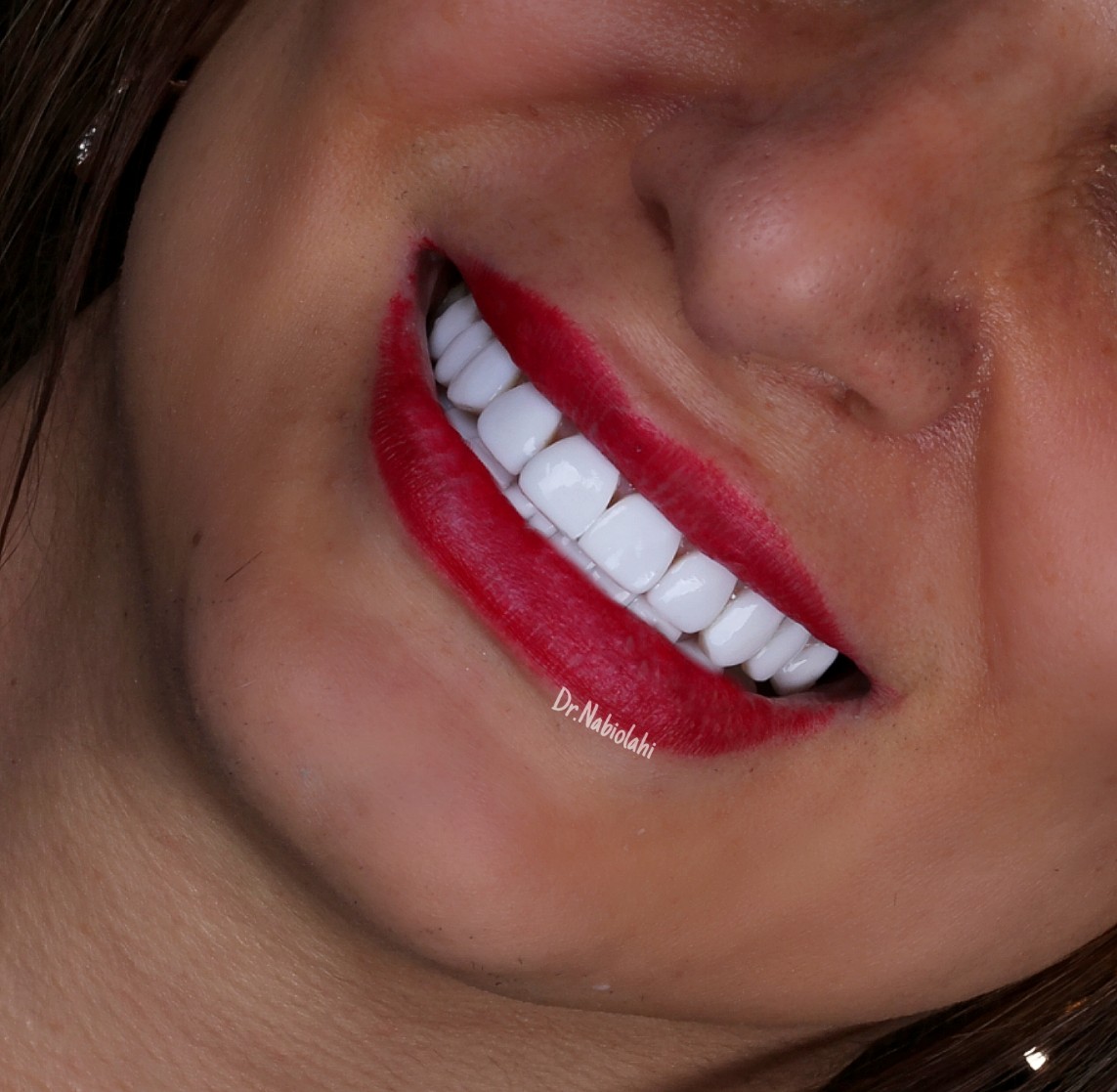 ونیر کامپوزیت