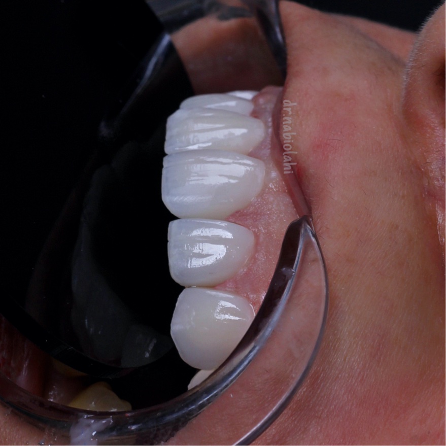 لمینت سرامیکی