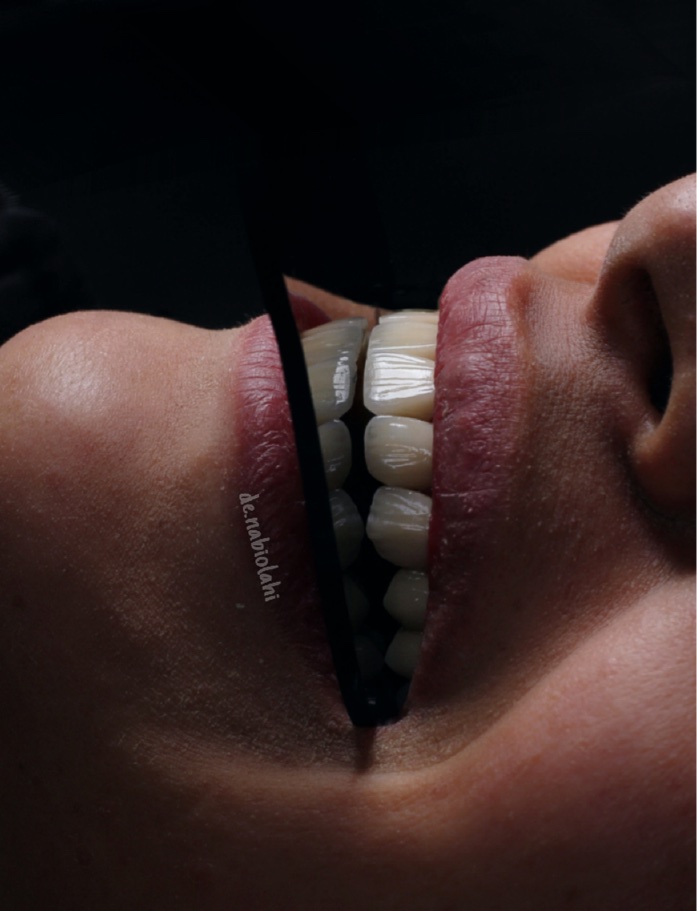 لمینت سرامیکی