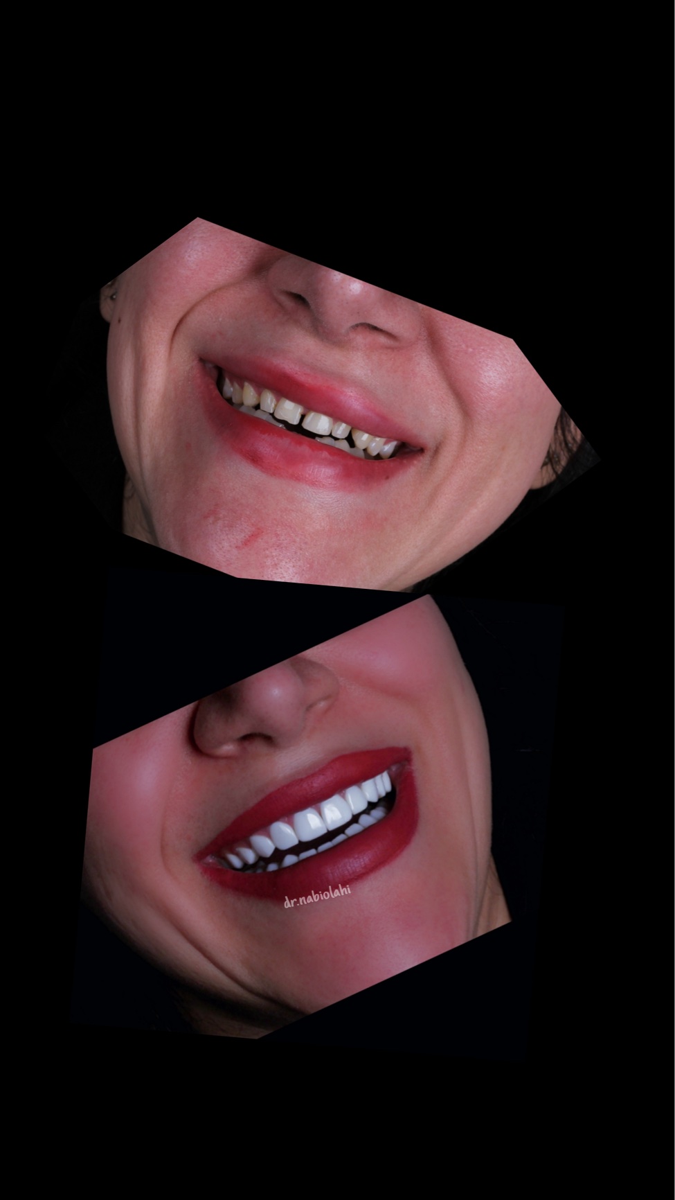 ونیر کامپوزیت