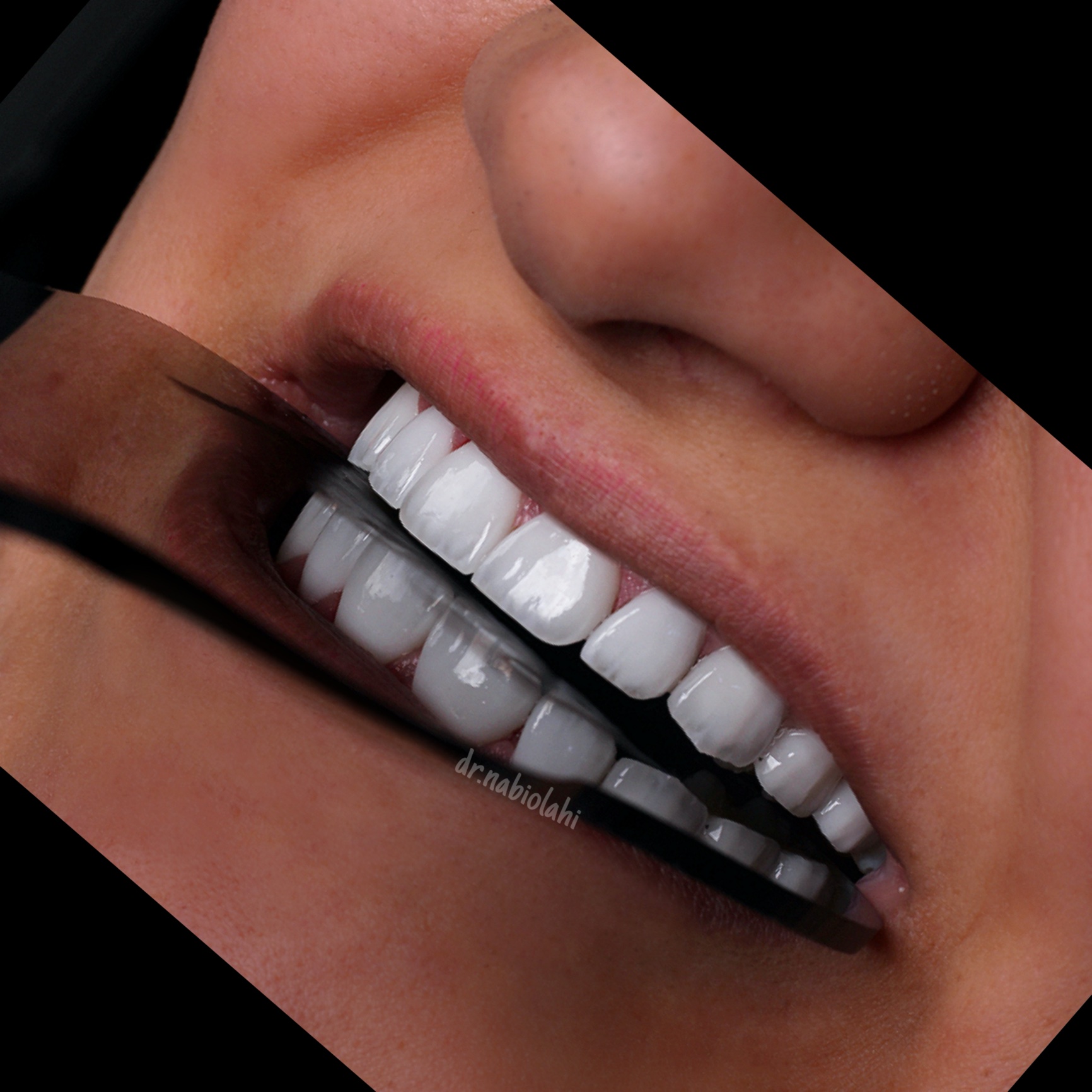 لمینت سرامیکی