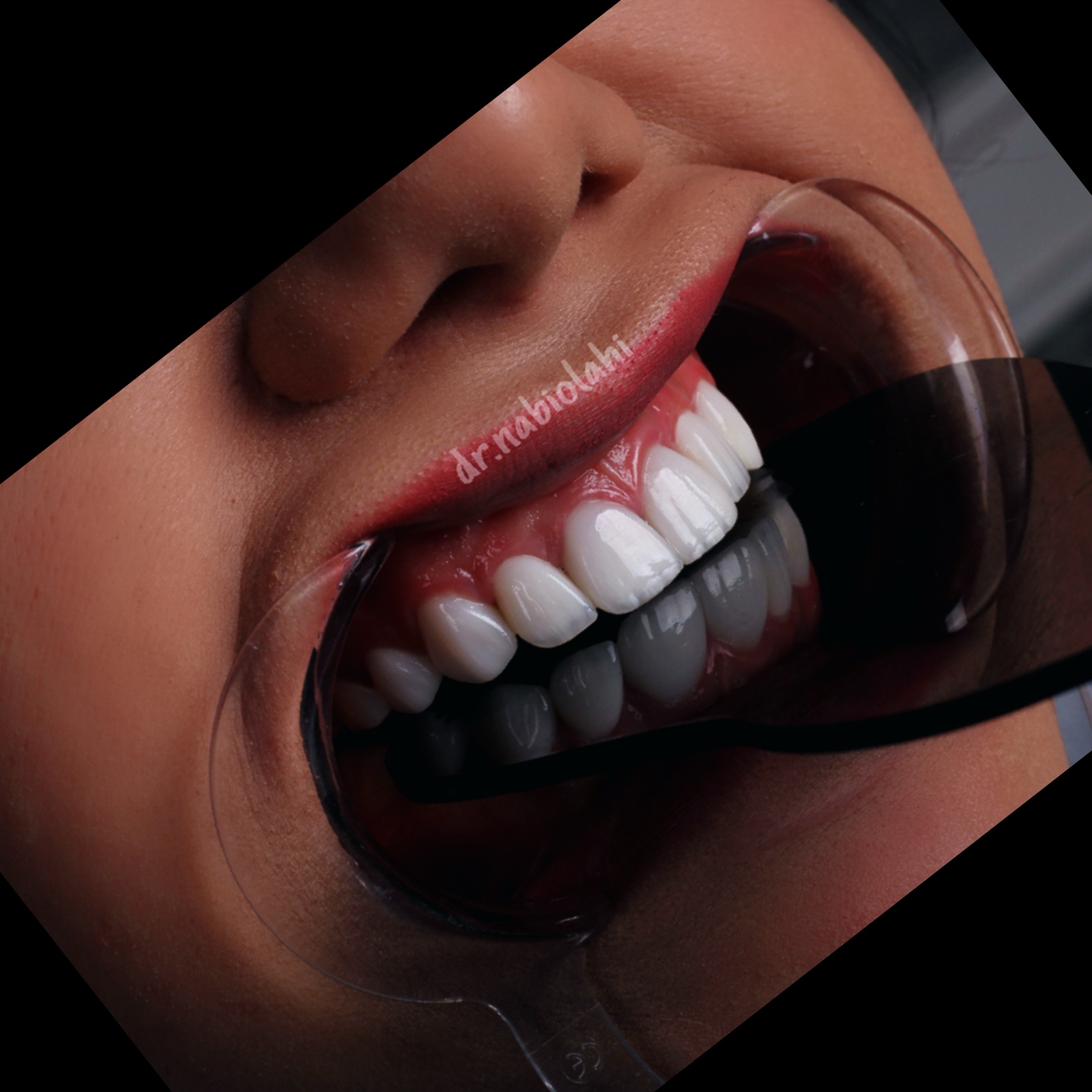 لمینت سرامیکی