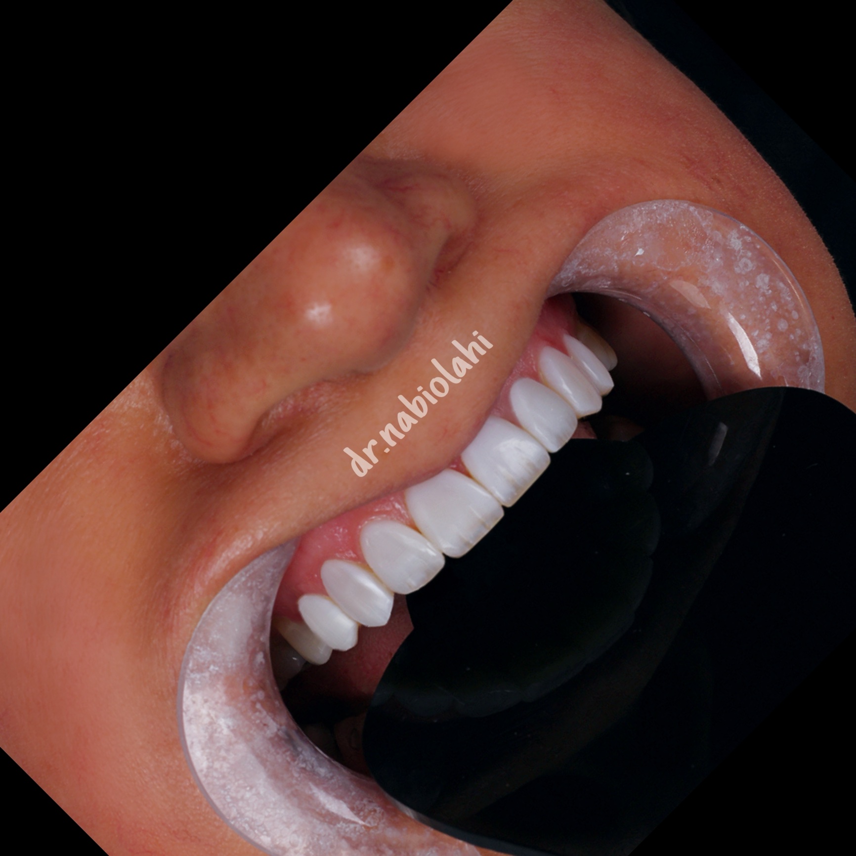 ونیر کامپوزیت