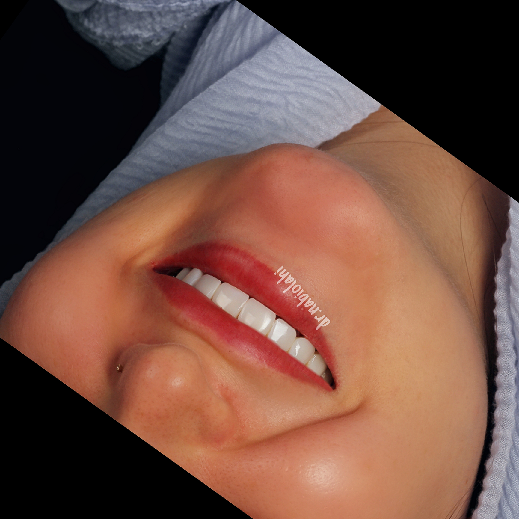 ونیر کامپوزیت