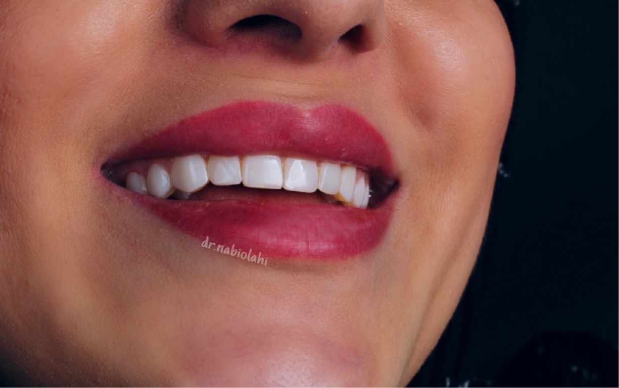 ونیر کامپوزیت