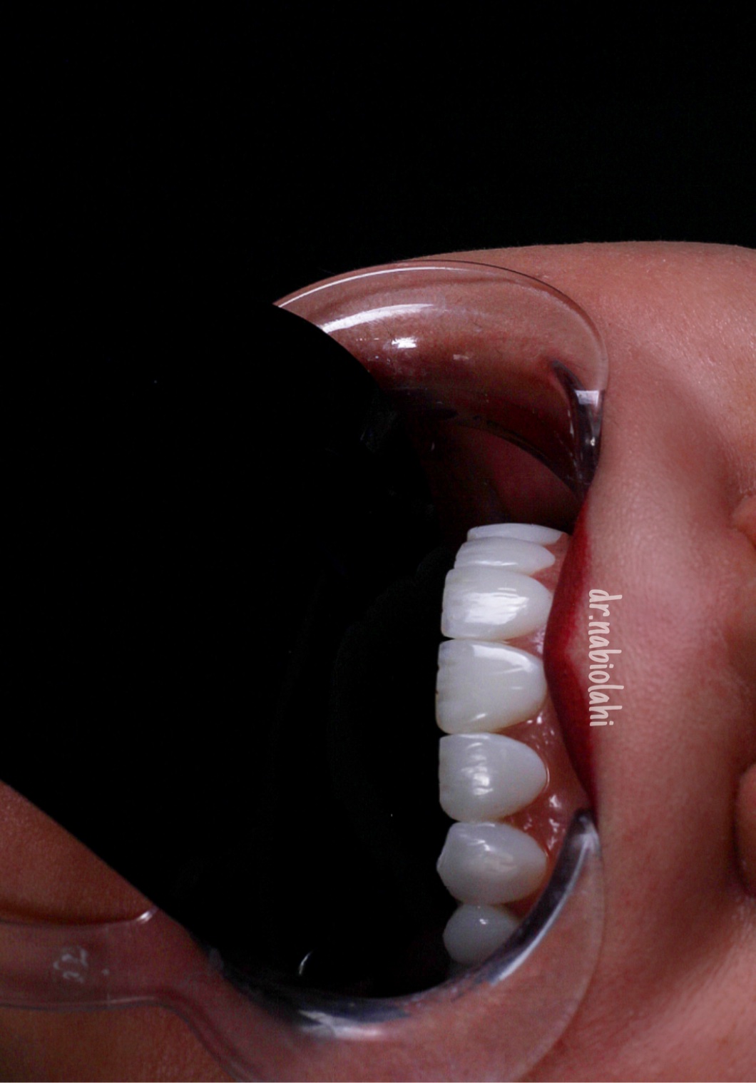 ونیر کامپوزیت